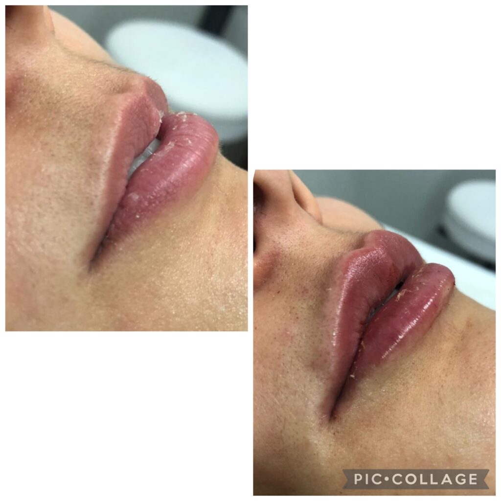 procedimento estético de labios